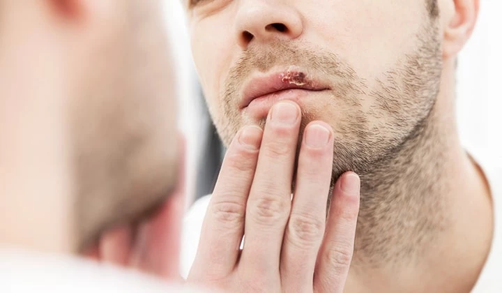 Mann mit Lippenherpes Mann mit Lippenherpes
