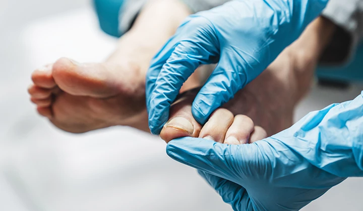 Nagelpilz behandeln Nagelpilz